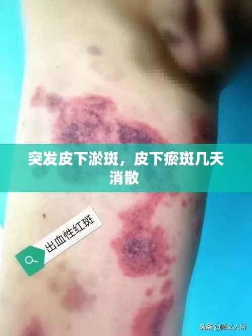 突发皮下淤斑,皮下瘀斑几天消散