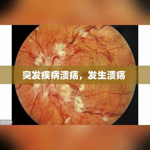 突发疾病溃疡,发生溃疡